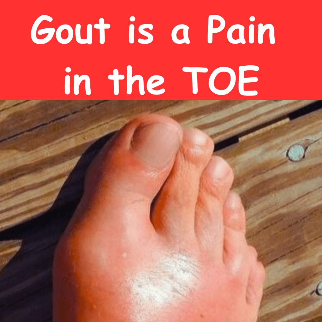 Gout is a Pain in the Toe - River Bend Medical Associates